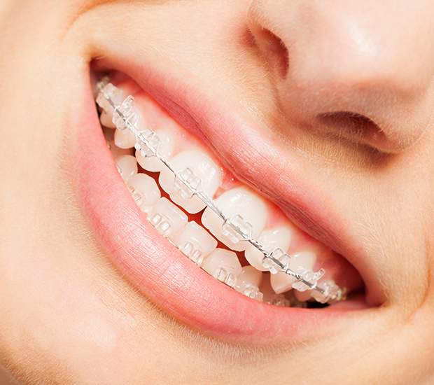 clear-braces Close-up of a smiling person wearing clear braces, showcasing straight teeth and a healthy smile, emphasizing orthodontic benefits for oral health and aesthetics at Smile Reflections in Tucson, AZ.