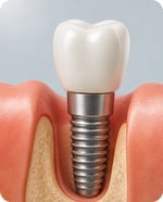 Dental Implants in Tucson AZ